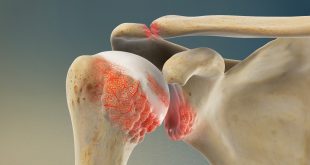 Rheumatoid Arthritis Shoulder Symptoms in Adults
